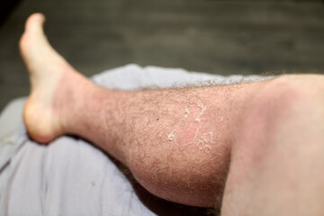 Sunburned leg displaying prominent desquamation in natural indoor setting. Soft lighting highlights...