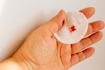 Tiny cut on fingertip, Close up injured thumb with bleeding skin, splinter wound on finger detail,...