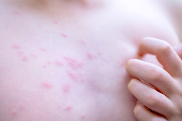 Preteen Child boy with red insect bug bites and rash on skin, scratching irritated skin, expressing...