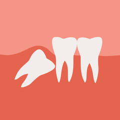 Impacted Wisdom Tooth Vector Illustration
