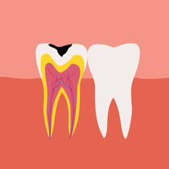 Decayed Tooth Cross Section Vector Illustration