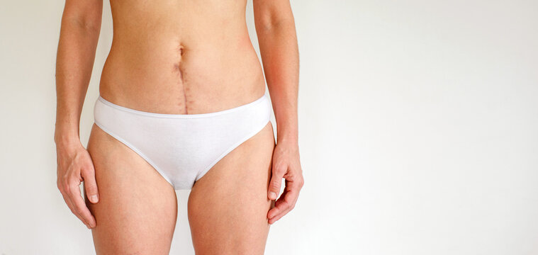 Woman's body with a scar on her abdomen from a surgical suture five months after gynecological surgery (hysterectomy), or after giving birth by cesarean section, close-up, copy space.