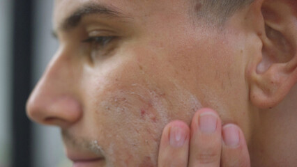 Young man applying acne controlling face wash for men to stop skin breakouts and acne scars, side view close up. Skin problem and disorder concepts.