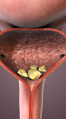 Bladder Stones Caused by Crystallized Urinary Minerals