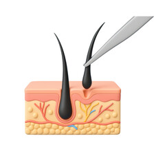 3D illustration of hair transplant surgery showing tweezers inserting hair follicles into scalp skin, symbolizing medical treatment, cosmetic solution, and hair restoration.