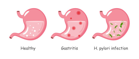 Stomach with medical condition including healthy, gastritis, Helicobacter pylori infection . Cartoon illustration . Isolated white background . Vector .