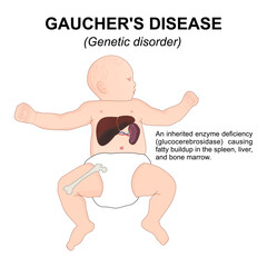 Gaucher's disease - Genetic disorder flashcard