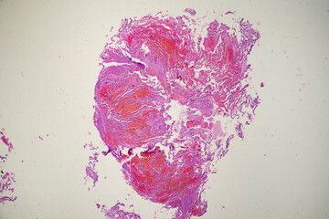 Microscopic image of lung and systemic lupus erythematosus.