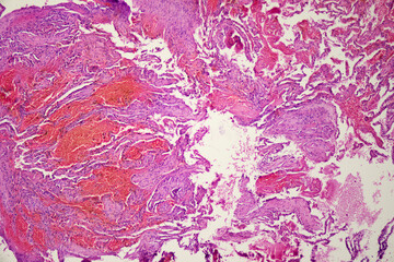 Microscopic image of lung and systemic lupus erythematosus.