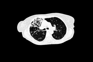 Medical themes: Chest CT scan showing bronchiectasis in a female patient