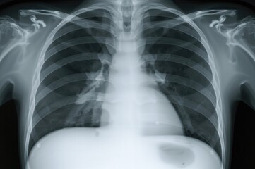 PA chest X-ray revealing uniform opacities in the left lower lung area indicative of loculated pleural effusion caused by tuberculosis