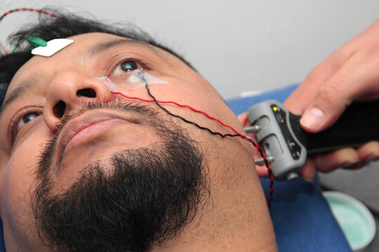 Electromyography EMG and facial nerve conduction velocity NCV to assess nerve damage from facial paralysis in a Latino male