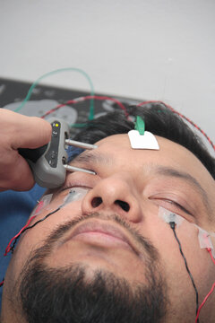 Electromyography EMG and facial nerve conduction velocity NCV to assess nerve damage from facial paralysis in a Latino male