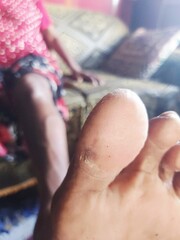 A close-up of a diabetic toe showing medical complications, used for health care and educational purposes.