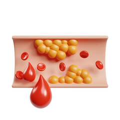Medical Illustration Depicting Cholesterol Buildup within an Artery with Red Blood Cells and Blood Droplets Transparent Background