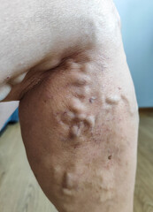 close-up of leg showing prominent varicose veins with twisted bulging bluish veins and small red broken capillaries on fair skin ideal for healthcare education, vascular treatment marketing