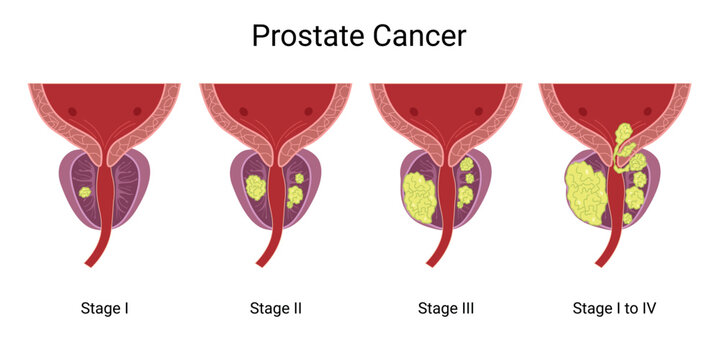 Prostate Cancer. Prostate Tumor. Normal Prostate and Enlarged Prostate Gland under Bladder. Normal prostate and prostate with cancer. Prostatitis is inflammation of the prostate gland. 
