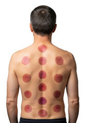 Naklejka premium Mid-40s caucasian man's bare back with deep red and purple cupping therapy marks in a sterile clinical studio, soft high-key lighting, transparent background, concept of alternative medicine