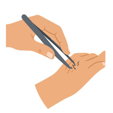 Removing a splinter from a hand with tweezers