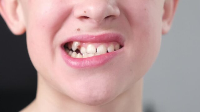 A boy or teenager demonstrates an abnormally grown canine tooth. Demonstration video for dentists.