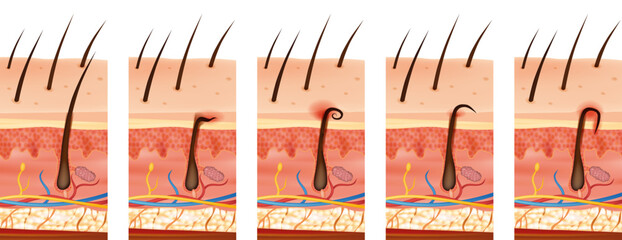 Different types of ingrown hairs in human skin cross-section. Illustration presents normal hair growth, hair trapped under the skin, curling back into the dermis, and inflamed ingrown hair. 