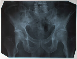 X-ray of the pelvic bones