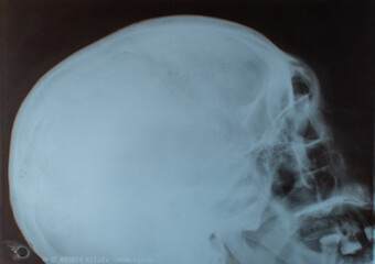X-ray of the skull