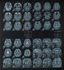 computed tomography of the human brain and skull