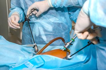 Surgical procedure with medical team performing laparoscopic technique in sterile environment