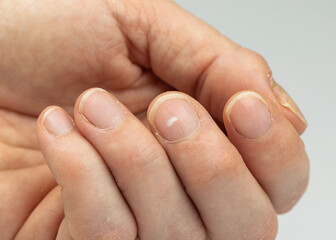 Close-up of a human fingernail with visible white spots, known as leukonychia. These marks are...