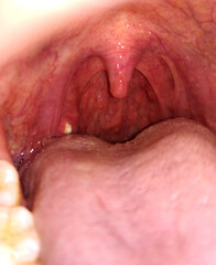 selective focus image of tonsil stones or tonsilloliths