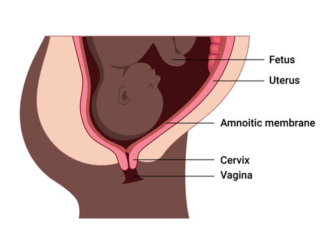 Cervical Effacement and Dilation. Various processes in the Uterus during Childbirth. Thinning and shortening of the Cervix. Detailed medical vector illustration. The fetus is in the uterus
