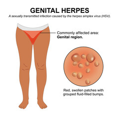 Genital herpes dark skin