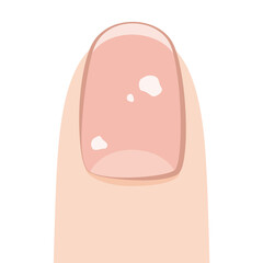 白い斑点がある爪