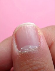 Fototapeta premium Close-up of a fingernail with imperfections