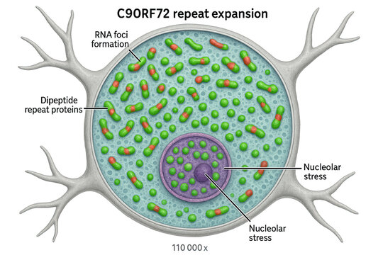 Illustration of C9orf72 repeat expansion in a neuron, showing dipeptide repeat proteins and RNA foci formation, leading to nucleolar stress.