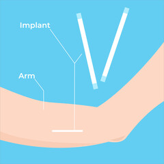 Illustration of contraceptive method using under-skin implant, great for reproductive health or medical education, flat art design style.
