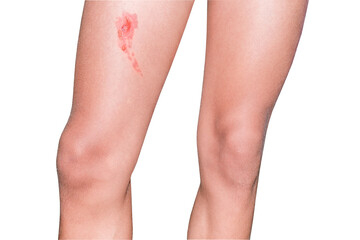 skin wound from burn on teenage boy leg, isolated on white background with clipping path