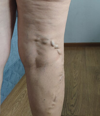 close-up of leg showing prominent varicose veins on thigh and knee in bright indoor home setting ideal for medical education, varicose vein treatment marketing, healthcare awareness
