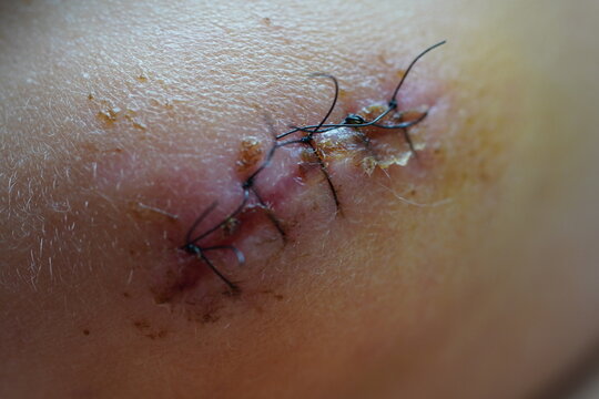 Stitches.