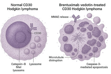 Medical illustration comparing normal CD30 Hodgkin lymphoma cells with brentuximab vedotin-treated cells, showing MMAE release, microtubule disruption, and caspase-3 mediated apoptosis.
