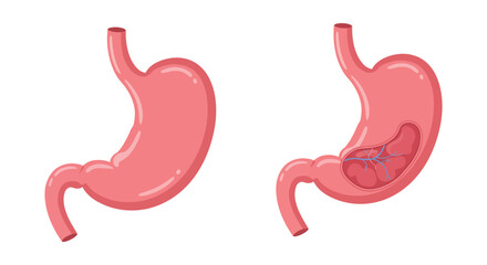 Healthy and Diseased Stomach Comparison Showing Gastric Ulceration and Inflammation