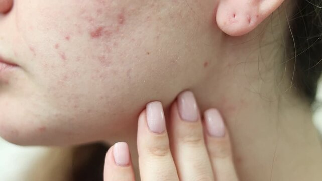  Close up video of a womans face with acne, pimples and post-acne scars. Skin problems, dermatology issues, skincare concept. Hand touching cheek, showing imperfections in detail. High quality 4k 