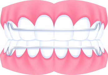 Full mouth teeth - Hawley retainer illustration transparent design. Dental care concept.