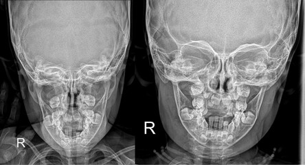 Pediatric mandible x ray PA © Radiographs