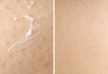 Dry skin on one side and moisturized on another, collage before and after