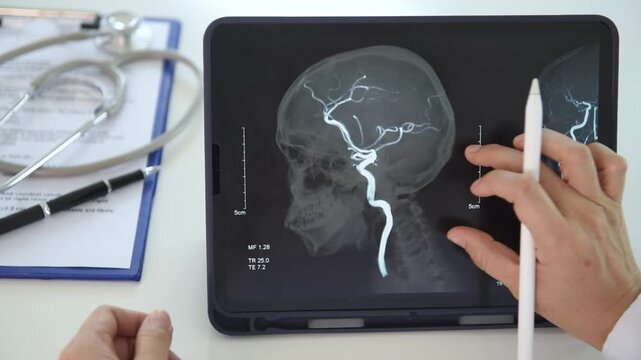 Neurosurgeon Doctor looking cerebral blood vessel x-ray image for diagnose ischemic stroke or cerebrovascular disease at brain disease hospital center.