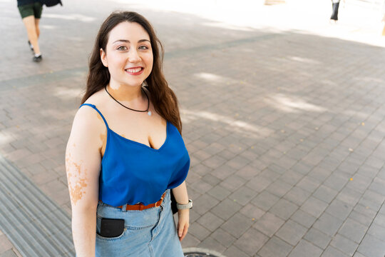 Spanish woman with vitiligo smiling outdoors - Powered by Adobe