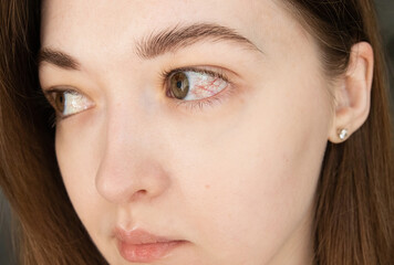 Close up of inflamed eye with vascular redness. Concept of ophthalmology, eye infection, conjunctivitis and dry eye syndrome.