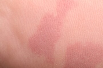 Macro view of dry human skin with red spots as background
